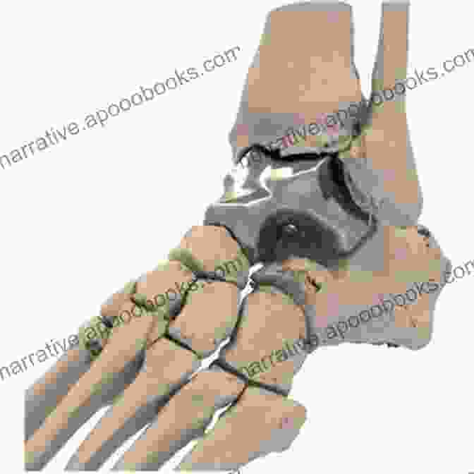 3D Printed Bone Graft For Foot Surgery New Techniques In Foot And Ankle Surgery