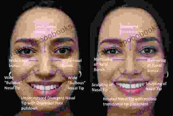 Closed Rhinoplasty: The Next Generation