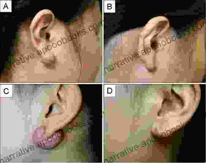 Depiction Of Various Treatment Modalities For Ear Keloids Atlas Of Ear Keloids Second Edition