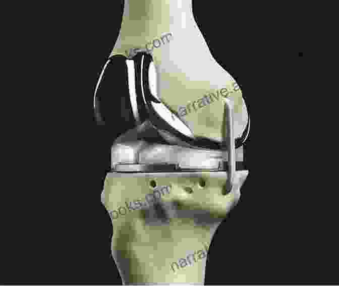 Image Of An Orthopedic Implant Being Placed In A Patient's Knee Applied Biomedical Engineering Mechanics James Bender