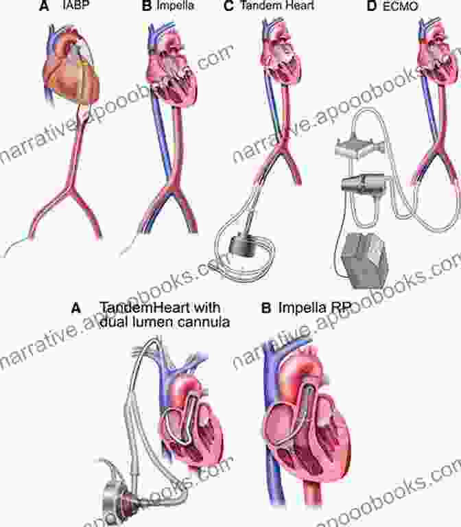 Mechanical Circulatory Support Device Mechanical Circulatory Support In End Stage Heart Failure: A Practical Manual