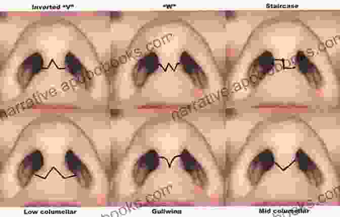 Nasal Tip Rhinoplasty Open Surgical Techniques Textbook Of Nasal Tip Rhinoplasty: Open Surgical Techniques