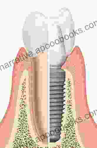 Atlas Of Immediate Dental Implant Loading