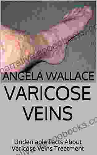 Varicose Veins: Undeniable Facts About Varicose Veins Treatment